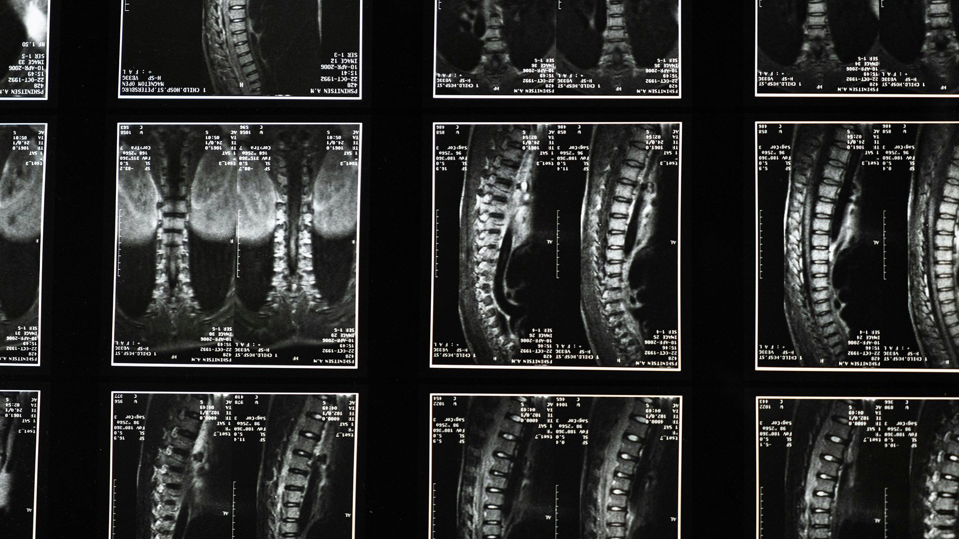 Medical imaging of a backbone