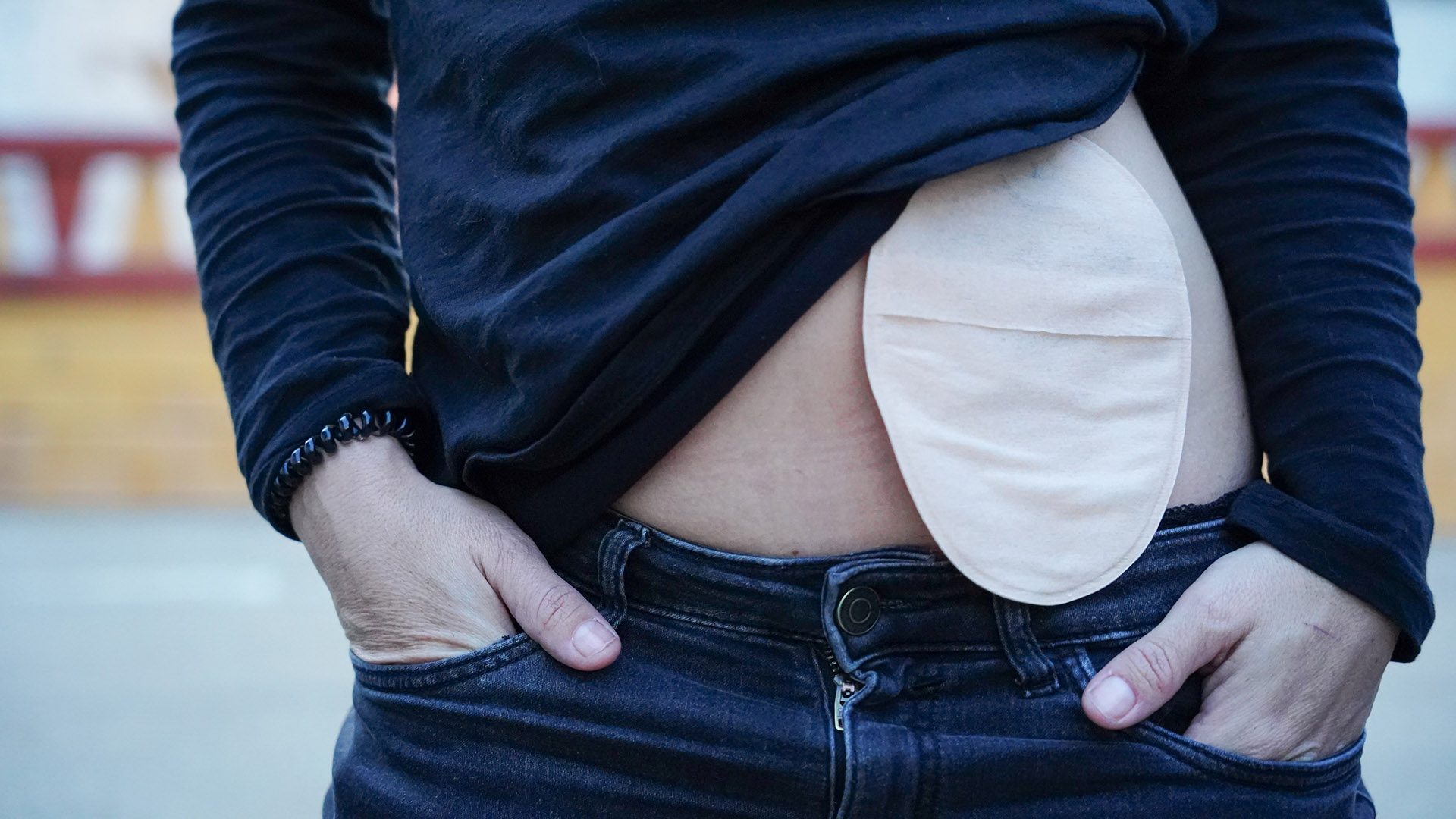 An unidentified person in dark clothing wears an ostomy bag